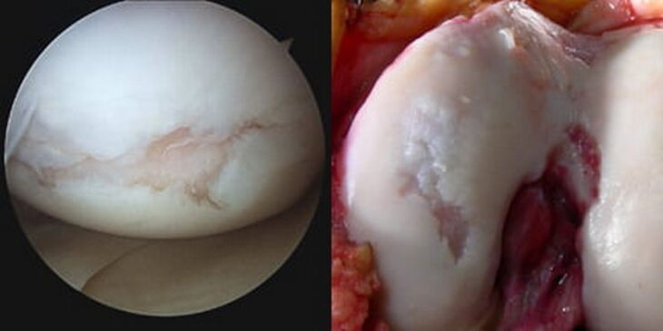 пошкодження колінного суглоба видно під час операції