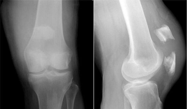 рентген колінного суглоба