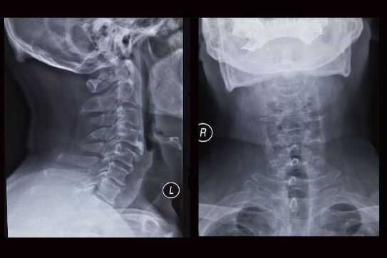 Рентгенологічний знімок шийного відділу хребта (у пацієнта – остеохондроз)