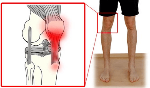 Тендиніт – запалення тканини сухожилля, що викликає біль у колінному суглобі. 