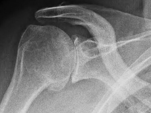 Рентгенографія плечового суглоба, ураженого артрозом