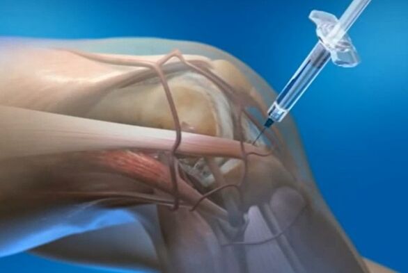 внутрішньосуглобові ін'єкції при артрозі колінного суглоба