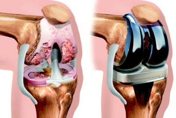 до і після ендопротезування колінного суглоба при артрозі